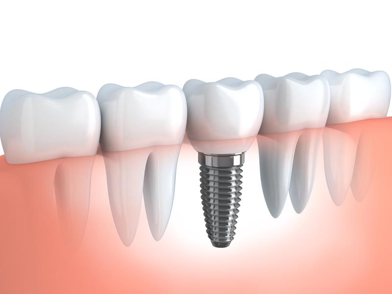 Dental Implants Tualatin, OR 